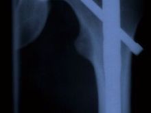 The reason I modified the handling of the stock Raptor. 8 days in hospital, and 4 Titanium accessories later. Remember quads are not meant to fly, but                                                  