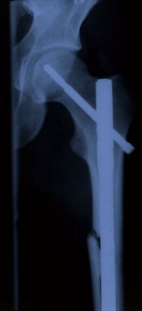 The reason I modified the handling of the stock Raptor. 8 days in hospital, and 4 Titanium accessories later. Remember quads are not meant to fly, but                                                  