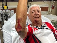 Stitches in elbow and chin.