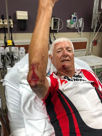 Stitches in elbow and chin.