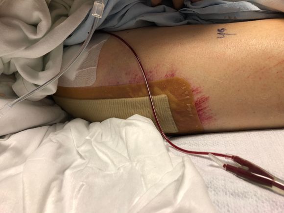 Drain post hip replacement 