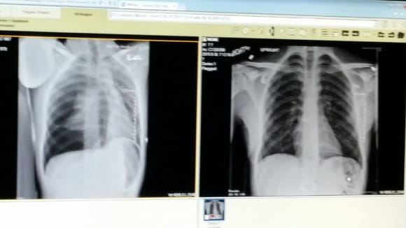 Practically no right lung yesterday. 97% inflated today. Still keeping me at the hospital for a couple days to watch it.