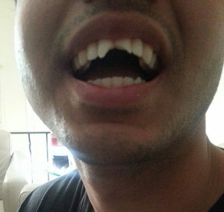 A photo of Hassam Khan's mouth, with his front teeth broken, following an incident with police during which he alleges his head was slammed on the hood of his cousin's car. (Courtesy of Harvey Greenberg)