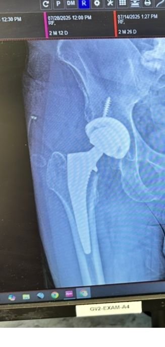 My new titanium and ceramic hip. 