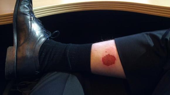 This is what you get when you ride wearing shorts and dismount on the high side!