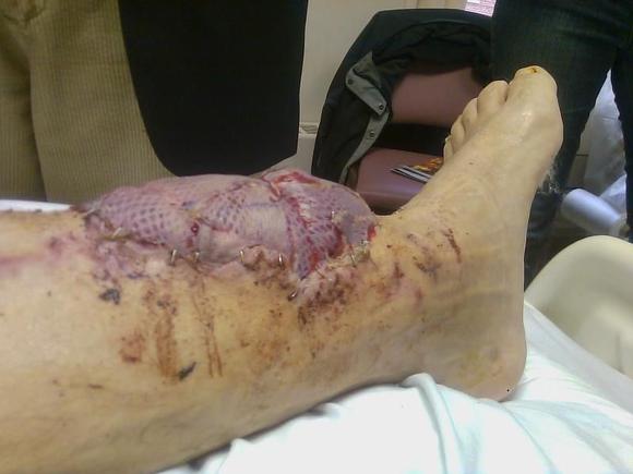 Flap &amp; Graft - January 2010