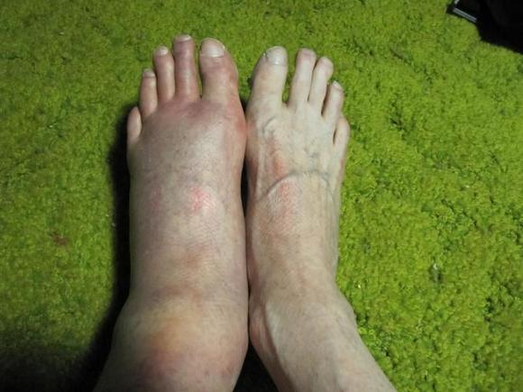 Broken fibula on KLX