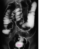 Colon Blow.jpg