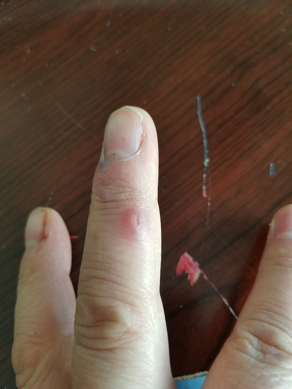 Anyone ever get "Fish Handlers Disease"? The Hull Truth Boating and